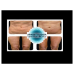 Ultrasonido corporal 1mhz y facial 3mhz +...